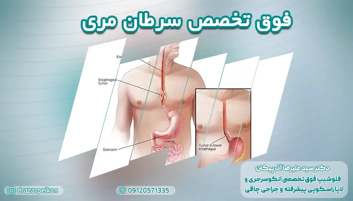 معرفی بهترین فوق تخصص سرطان مری در تهران
