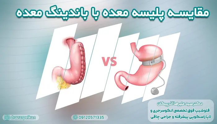 مقایسه باندینگ معده با پلیسه معده