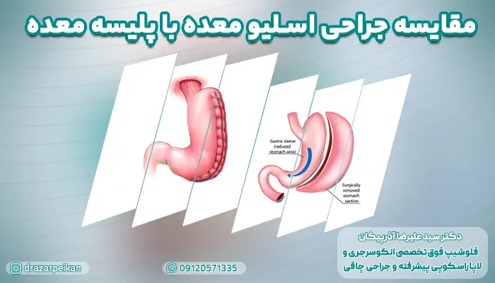 مقایسه جراحی اسلیو معده با پلیسه معده