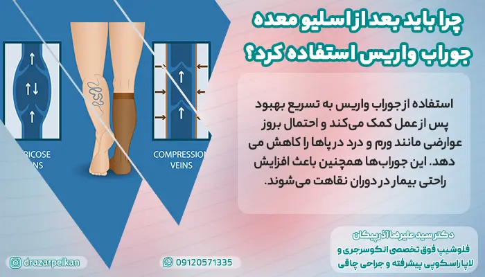 علت استفاده از جوراب واریس بعد از اسلیو معده