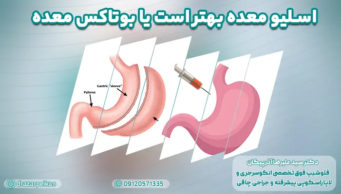 عمل اسلیو معده بهتر ست یا بوتاکس معده؟