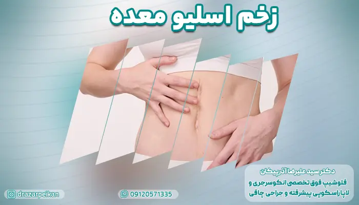 مراقبت های زخم اسلیو معده