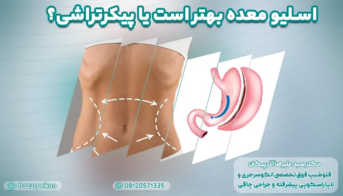 اسلیو معده بهتر است یا پیکرتراشی؟