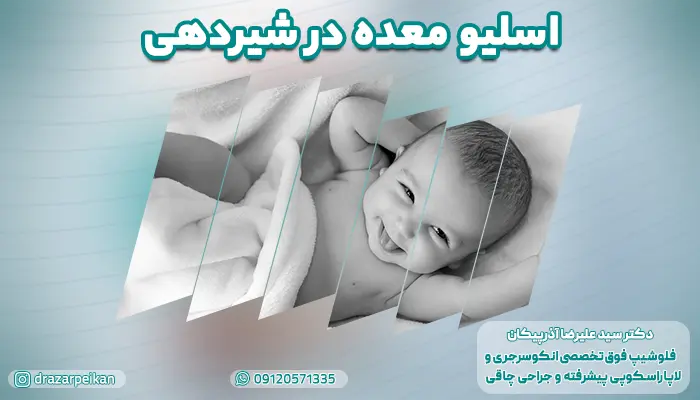 اسلیو معده در شیردهی