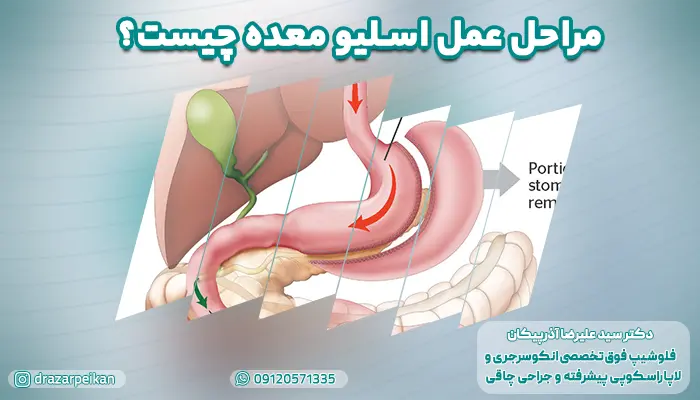 مراحل عمل اسلیو معده
