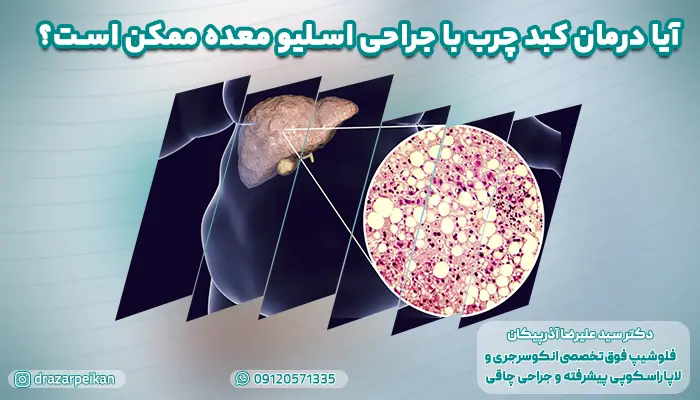 عمل اسلیو معده برای درمان کبد چرب