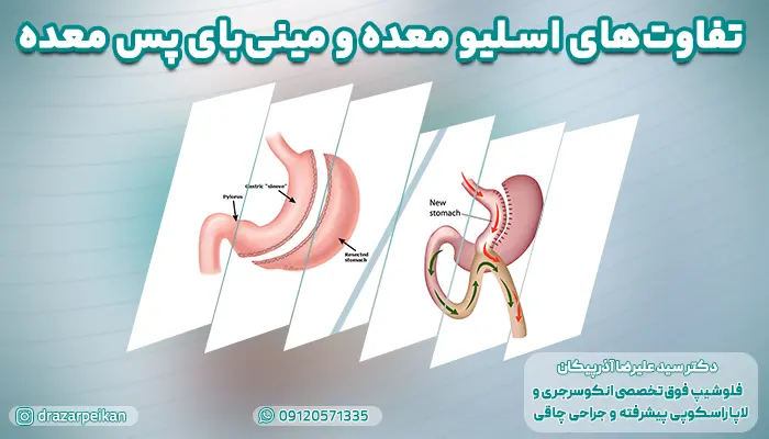 عمل اسلیو بهتر است یا مینی بای پس معده