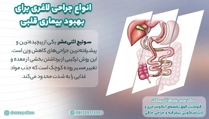 انواع جراحی لاغری برای بهبود بیماری قلبی