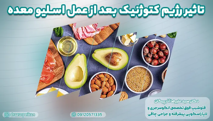 رژیم کتوژنیک بعد از عمل اسلیو معده