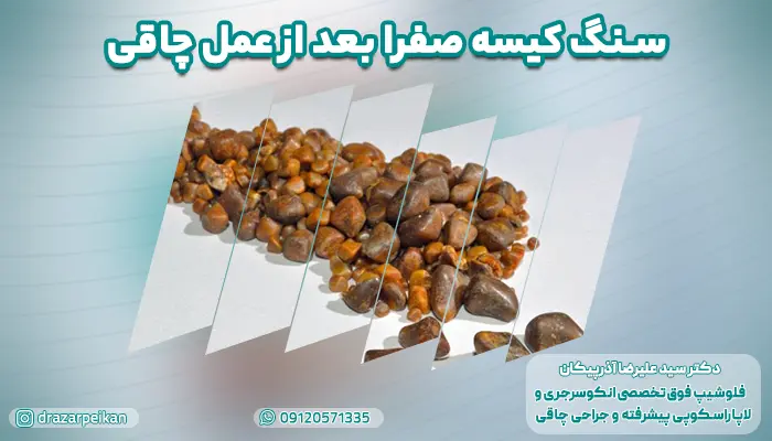 سنگ کیسه صفرا بعد از عمل چاقی