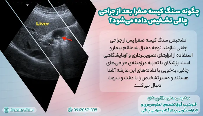 روش های تششپخیص سنگ کیسه صفرا بعد از جراحی چاقی
