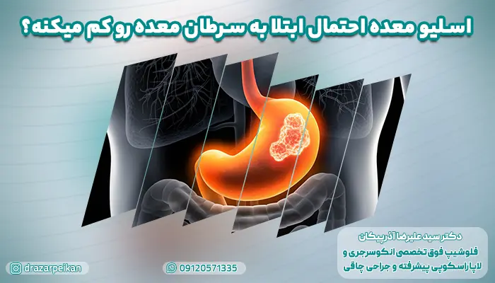 اسلیو معده احتمال ابتلا به سرطان معده رو کم میکنه؟