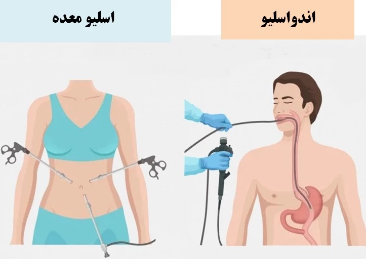 اندو اسلیو چیست؟ تفاوت عمل ایندواسلیو و اسلیو + مزایا و معایب