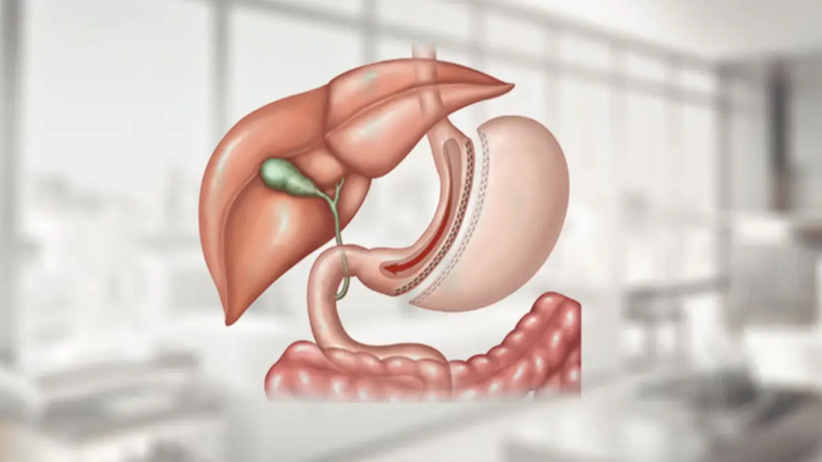عمل اسلیو معده در افراد دیابتی | تاثیر جراحی بر کنترل قند خون