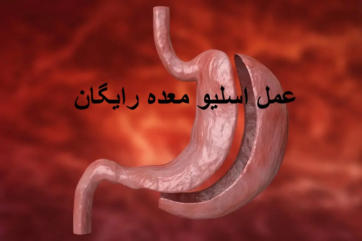 عمل اسلیو معده رایگان | اطلاعات کامل شرایط رایگان اسلیو معده