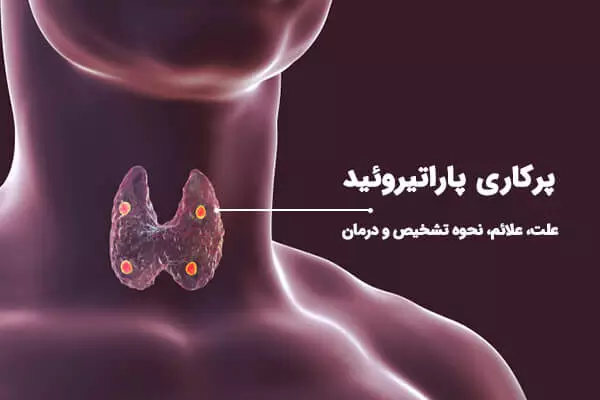 علت بالا بودن هورمون پاراتیروئید | دلیل و علائم پرکاری پاراتیروئید چیست؟