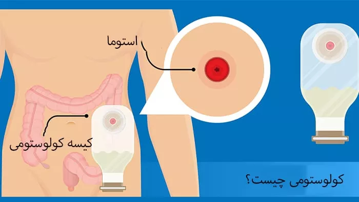 کولوستومی چیست؟ (Colostomy) + انواع عمل کلستومی و مراقبت ها