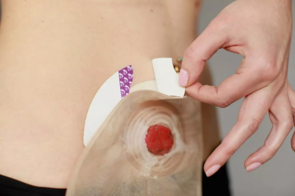 کیسه استومی چیست؟ Ostomy + انواع و مراقبت از استوما