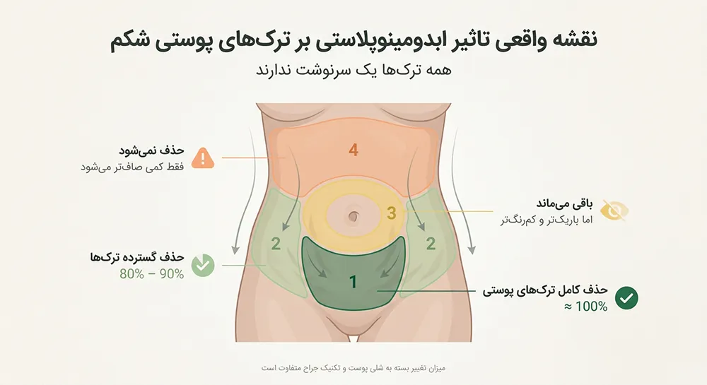اینفوگرافیک کدام ترک های پوستی در ابدومینوپلاستی حذف میشوند؟